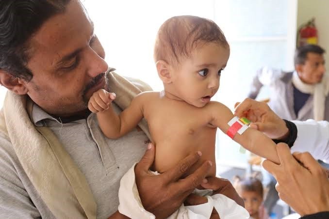 Setiap 10 Menit, Bayi di Yaman Meninggal Karena Kelaparan Akut