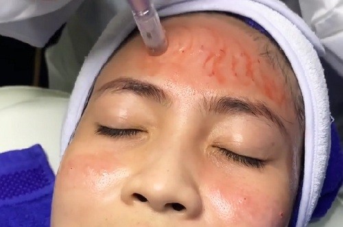 Cara Ampuh Mengatasi Bopeng Bekas Jerawat