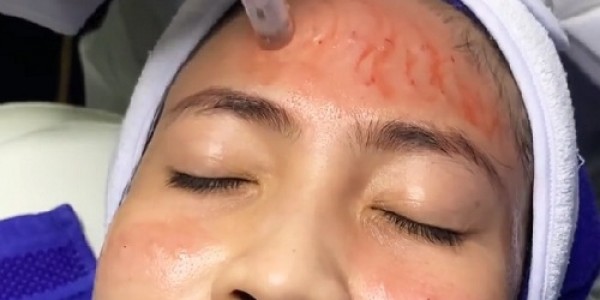 Cara Ampuh Mengatasi Bopeng Bekas Jerawat