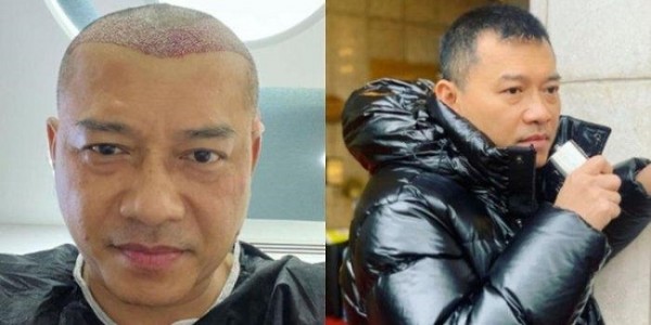 Anang Hermansyah Transplantasi Rambut di Turki, Ini Risiko dan Efek Sampingnya