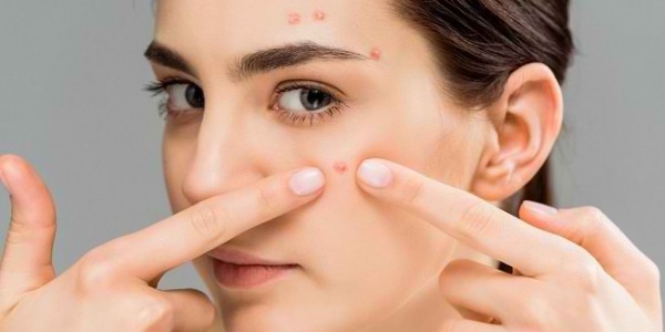 Berikut Tips Atasi Jerawat Secara Alami